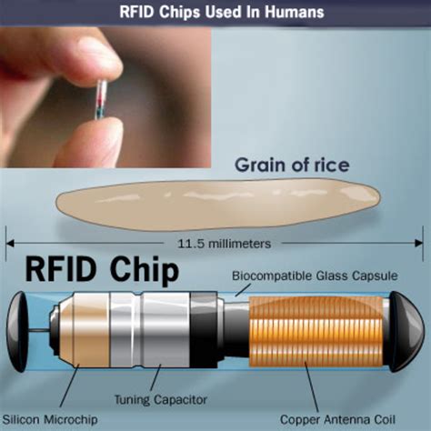 rfid chip removal surgery|rfid chip implantation.